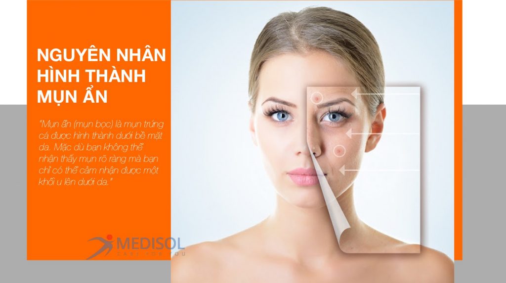 mụn ẩn